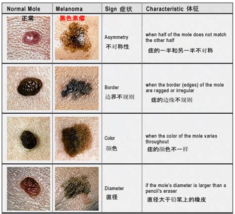 痣上面長痘痘|点痣不正规可能引发癌变：关于痣的 4 个常识